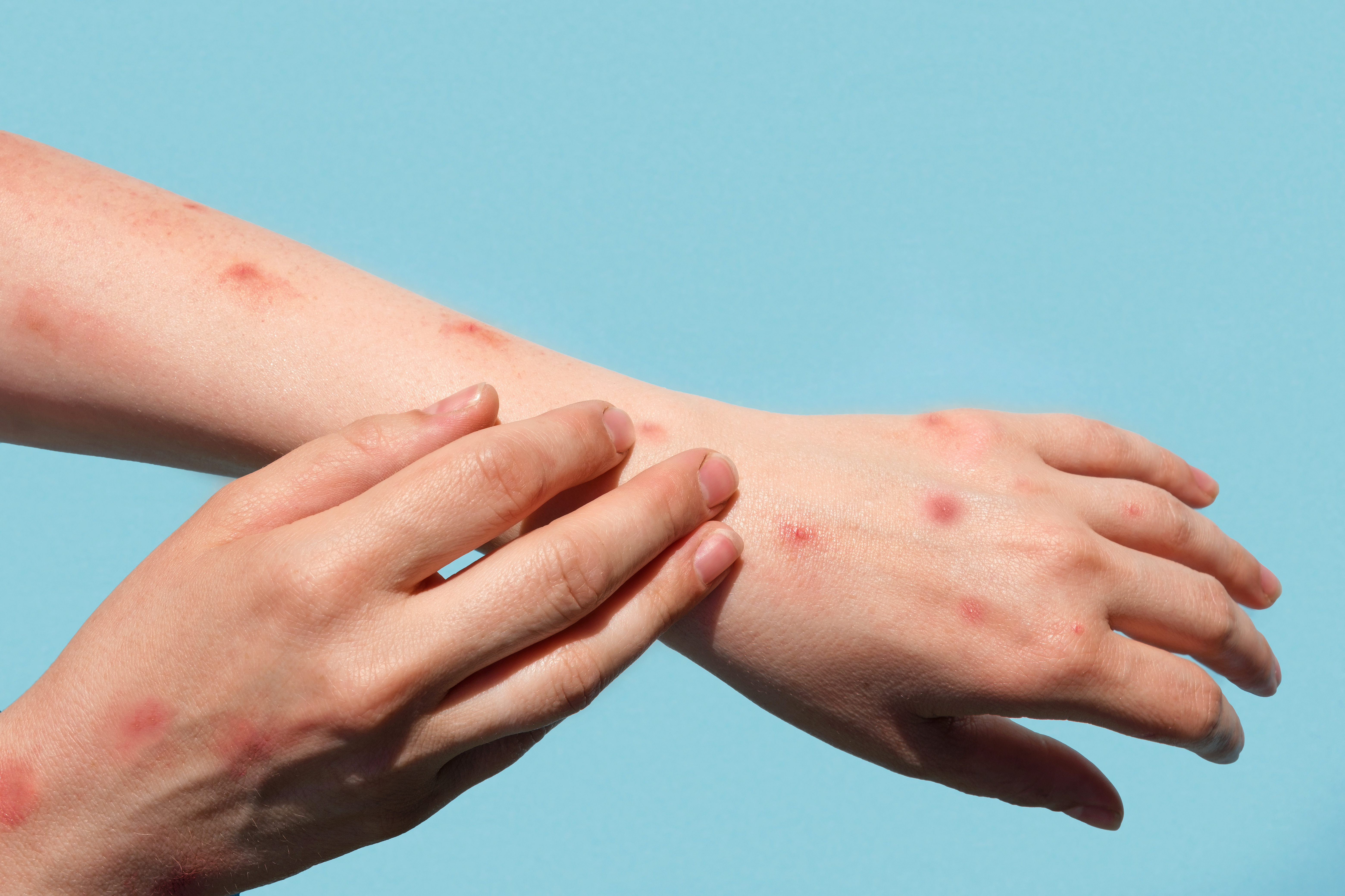 Mpox cases UK: Where did mpox come from and how does it spread? History of virus as two more cases detected