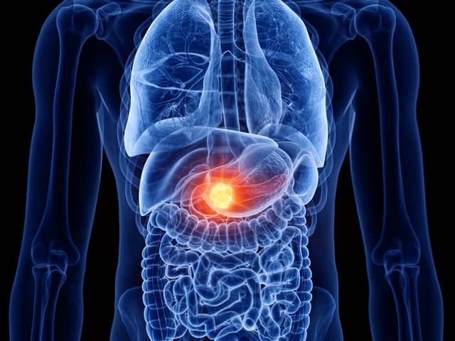 Here are signs of pancreatic cancer you can look out for 