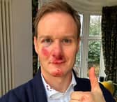 Dan Walker says he has no memory of the crash which left him bloody and bruised. Credit: Dan Walker