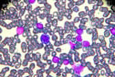 New treatment for children and adults with leukaemia (photo: Getty Images/iStockphoto)