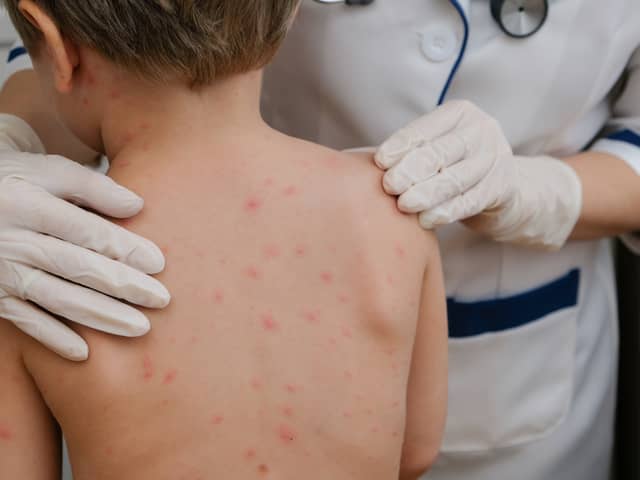 The Joint Committee on Vaccination and Immunisation has recommended that the NHS admminister the chickenpox vaccine to children aged 12 months to 18 months. (Credit: Adobe)