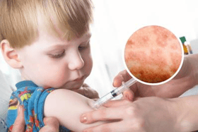 A national incident has been declared following a rise in Measles cases.