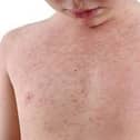 A national incident was announced in January due to the rising cases in measles across the country.