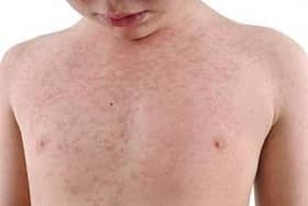 A national incident was announced in January due to the rising cases in measles across the country.