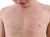 Measles in Portsmouth: What are the symptoms and what should you do if you have it?
