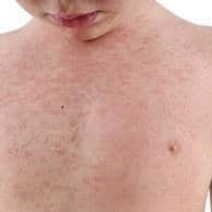 A national incident was announced in January due to the rising cases in measles across the country.