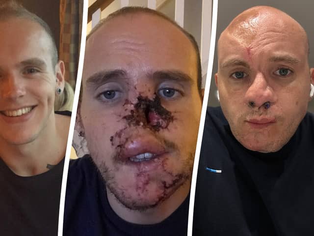 Ben Horne, who lost his nose when his dog ripped it off while trying to save him from a seizure has undergone ten reconstructive surgeries - using bones from his ribs.