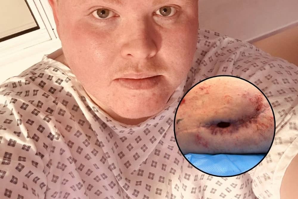 Tom Moss' hole in his leg | Tom Moss / SWNS