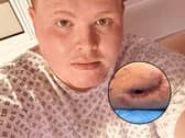 Tom Moss' hole in his leg | Tom Moss / SWNS