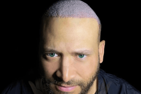 Aslı Tarcan Clinic is a leading destination for anyone considering hair transplant procedure in Turkey
