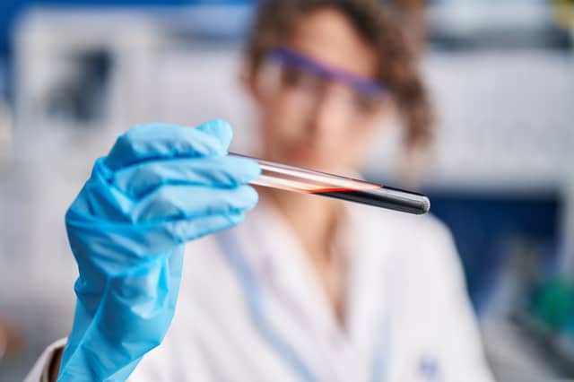 The new blood test can remove barriers to an early diagnosis