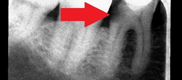 An X-ray showing the dental decay and infection on Stuart's tooth.