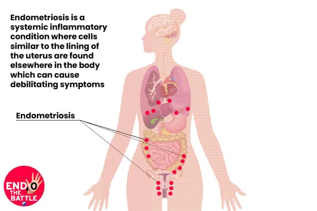 An estimated 1.5 million women in the UK live with endometriosis.