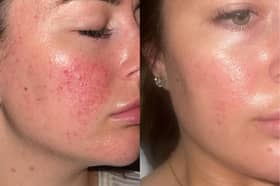 These are before and after images of Jamie, another 47 Skin user
