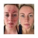 Customers share amazing before and after results of skincare brand that took the world by storm - Abigail's results 47 Skin 