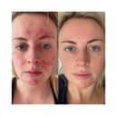 Abigail's results 47 Skin 