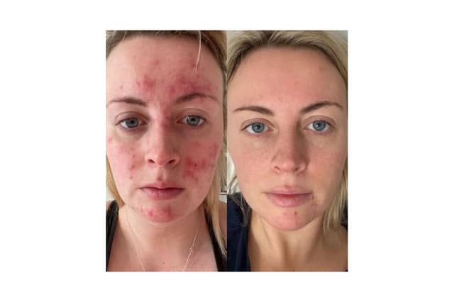 Abigail's results 47 Skin