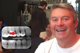 Kevin Brookes, 51, from Waterlooville, was awarded £7,000 in compensation after tooth decay went undiagnosed across multiple teeth.