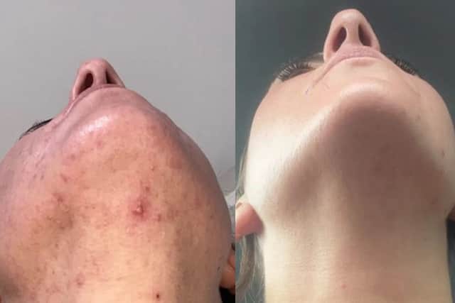 Blemishes be gone - the difference is clear when using the Chitoderm formula