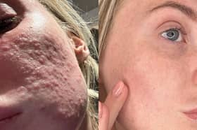 Real-life results: this user shared her skin journey after switching to a gentler, long-term skincare approach.