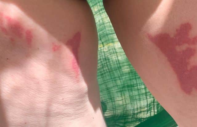 Denise Elliott’s thigh burns on Ryanair flight which led to accusations she lied