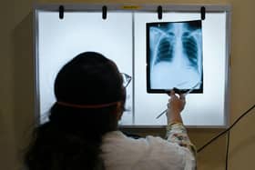 TB is a bacterial infection that affects the lungs.