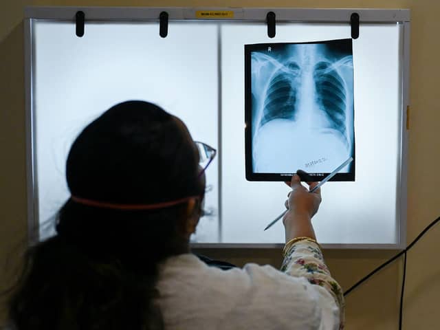 TB is a bacterial infection that affects the lungs.