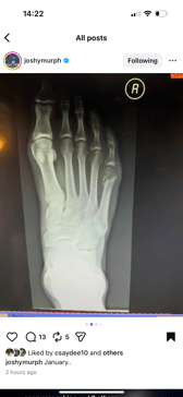Josh Murphy's picture on Instagram, showing an apparent metatarsal fracture.