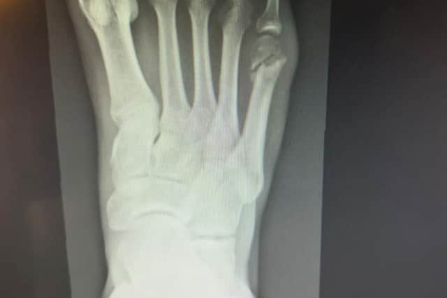 A x-ray showing Josh Murphy's fractured metatarsal. Pic: Josh Muprhy/Instagram