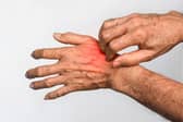 Scabies is highly contagious and spreads easily through close contact.
