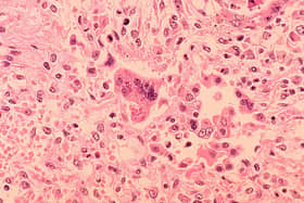 An outbreak of measles has been reported in London.