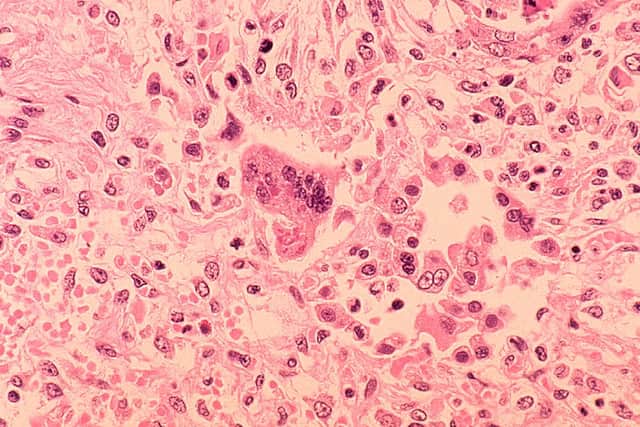 An outbreak of measles has been reported in London.