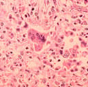 An outbreak of measles has been reported in London.