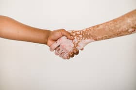 Around 1 in 100 people in the UK live with vitiligo.