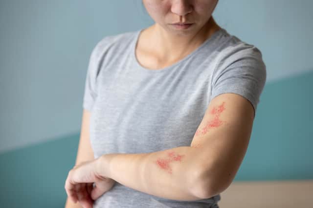 Those who are eligible for the shingles vaccine are being urged to come forward.