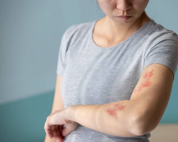 Those who are eligible for the shingles vaccine are being urged to come forward.