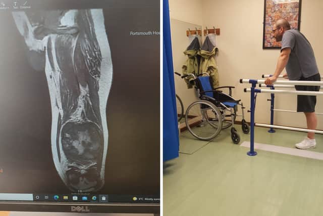 Shane had to learn how to walk again after having his leg amputated. The tumour below his right knee had grown to the size of a grapefruit.