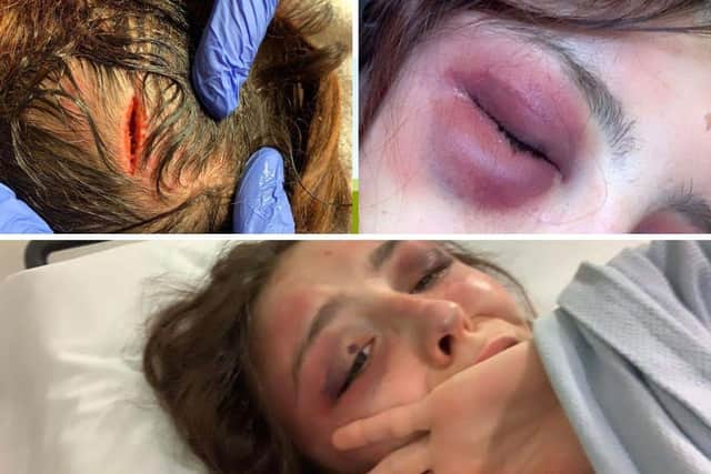 Injuries inflicted on Anisa Hutchinson by Jake Gurr, who was jailed at Portsmouth Crown Court for 12 and a half years