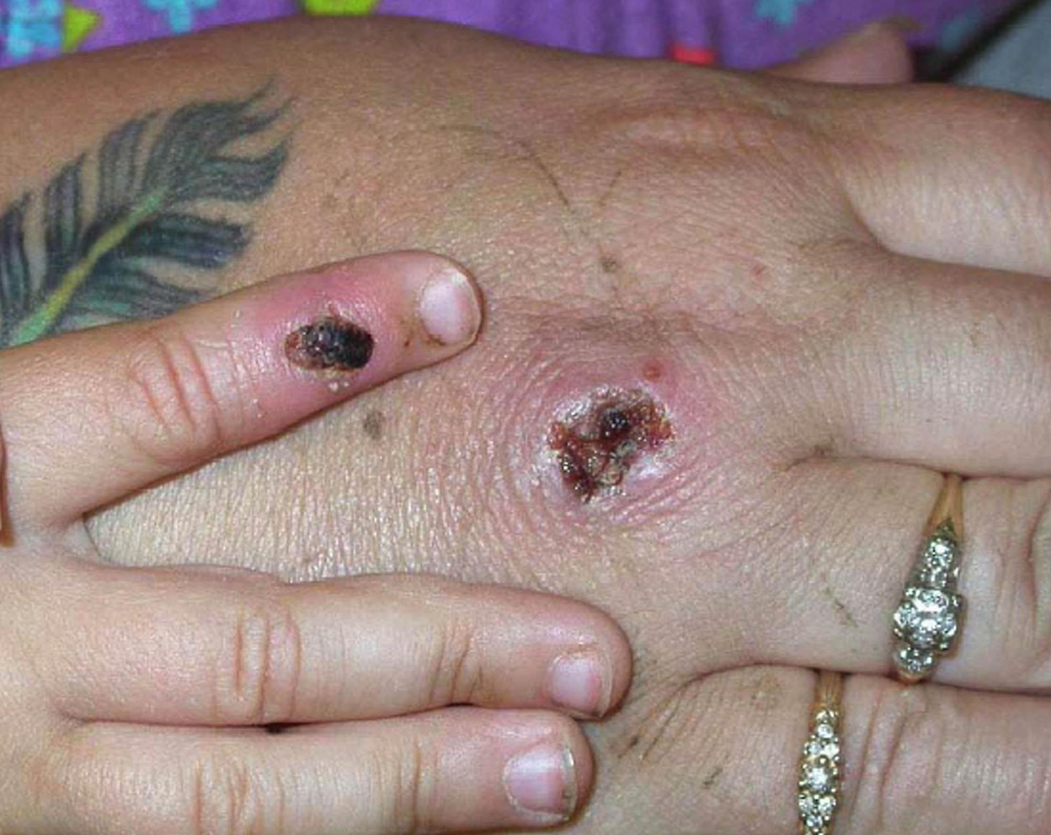 Two more Monkeypox cases confirmed in UK