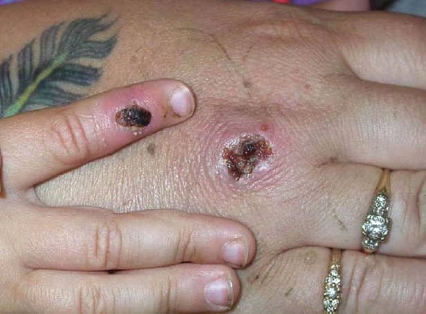 Two more cases of Monkeypox have been confirmed in the UK. Photo Courtesy of CDC/Getty Images