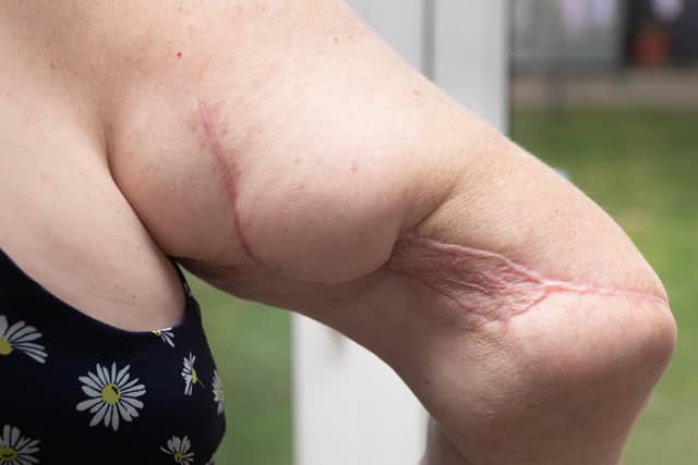 Pictured is: Gwen Rickman's scar she has as result of the accident

Picture: Keith Woodland (211121-5)