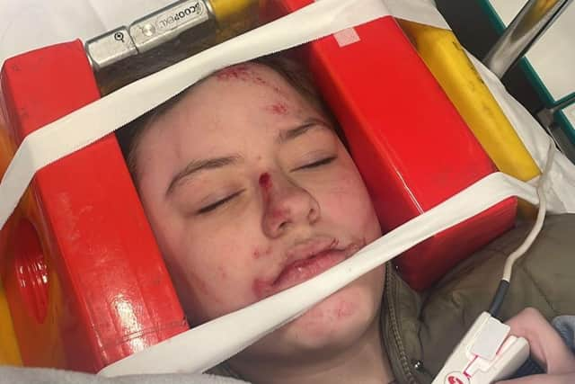 Millie-Rae Herbert was unconscious for 30 minutes following the collision and has been left with broken teeth, a broken nose and various other injuries to her head and body.

Picture: Michelle Price