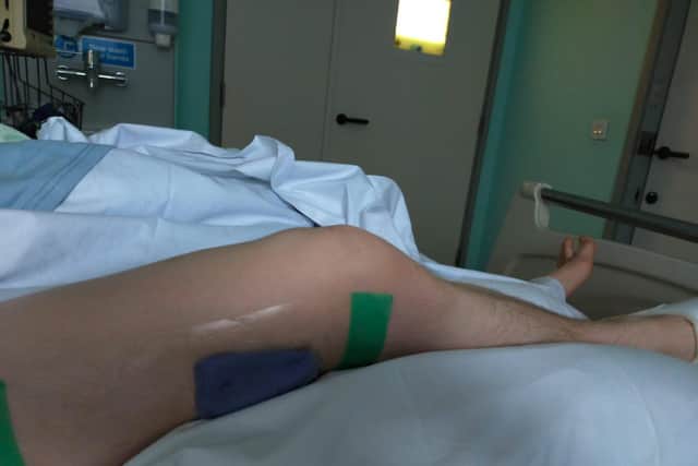 Moped rider Harry Silver broke his right leg in a crash with a car on Hayling Island. Picture: Harry Silver