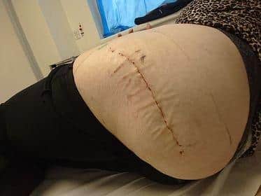 After surgery.