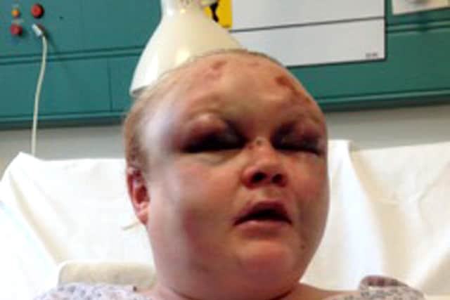 Sarah Mullings, 37, of Copnor, who suffered 70 blows when Karen Hanley, 37, of Eastern Road, attempted to murder Sarah between January 1 and 4, 2015. Hanley admitted
attempted murder at Portsmouth Crown Court on June 17, 2015.
Pictured: Sarah Mullings at Queen Alexandra Hospital in Cosham following the attack.