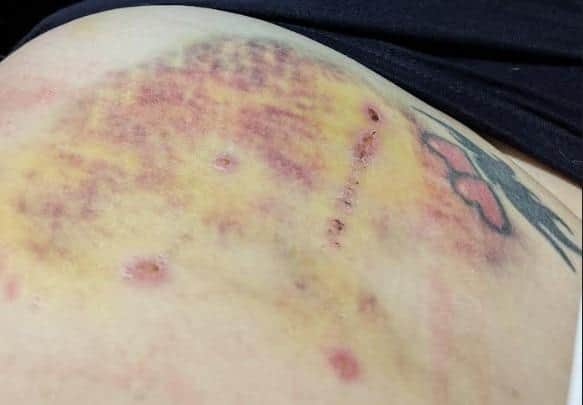 The victim's injured stomach following the XL Bully attack
