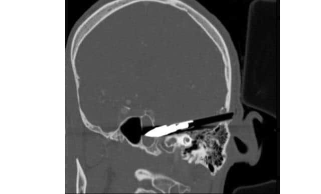 An X-ray of a crossbow bolt lodged in the victim's brain, after he was shot by Marcel Melinte from close range with a crossbow.