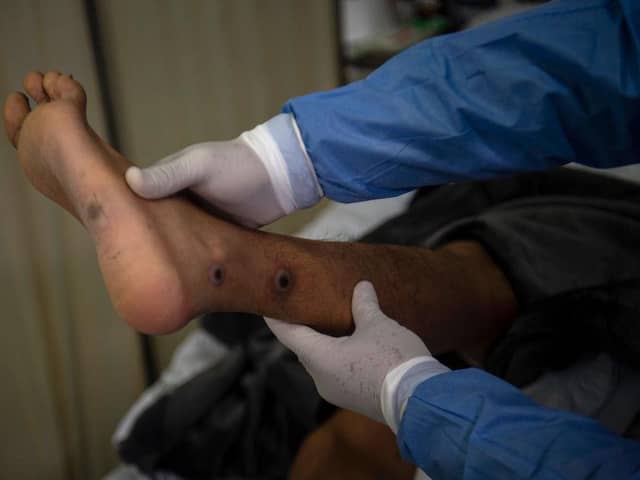 A doctor checks on a patient with sores caused by an mpox infection in 2022. (Photo by ERNESTO BENAVIDES/AFP via Getty Images)