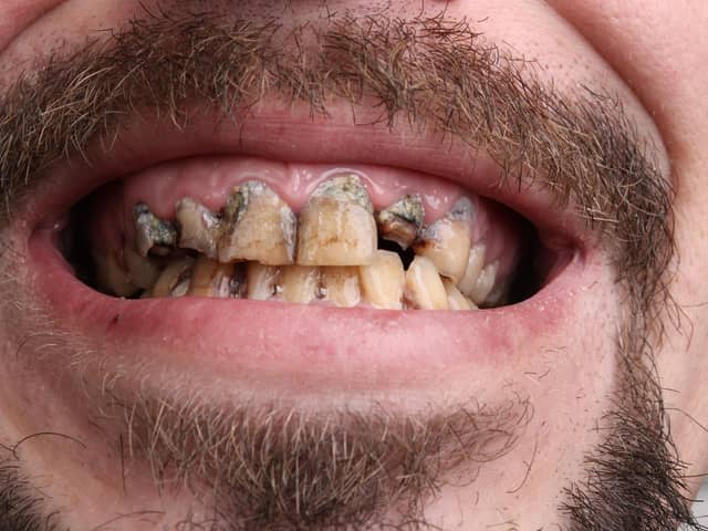 A man pictured with rotten teeth