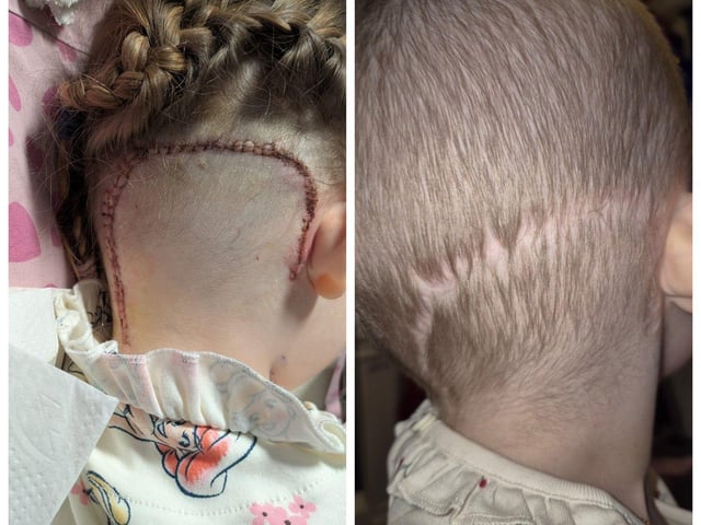 Dulcie faced a 10-hour operation to remove a tumour from her brain.